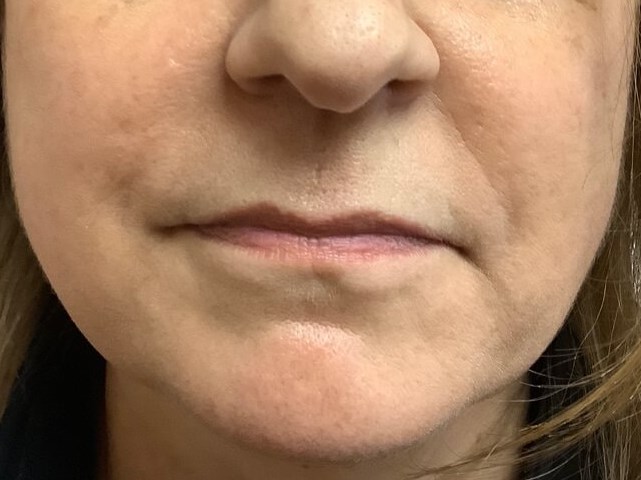 Juvederm Ultra XC After