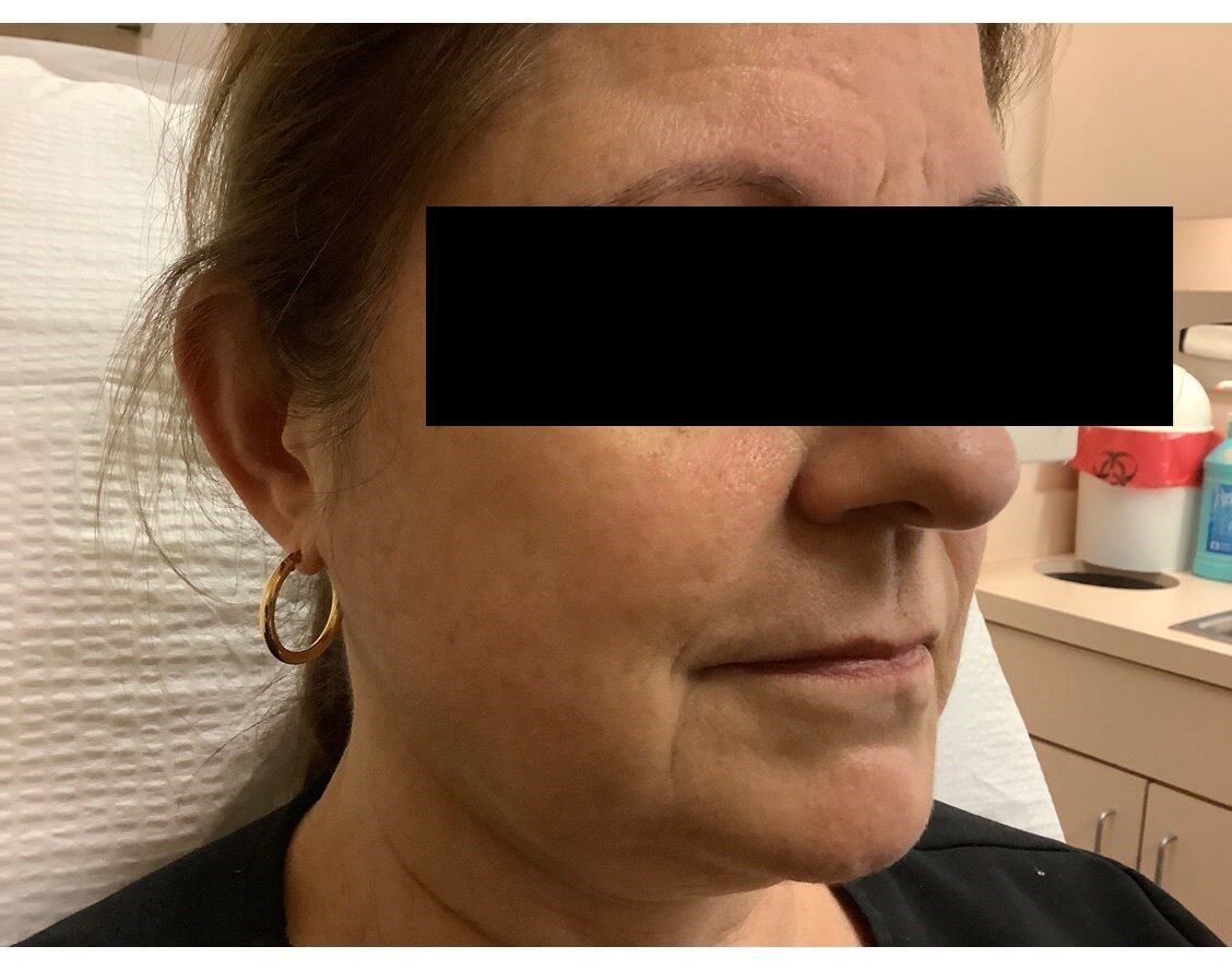 Juvederm Ultra XC Before