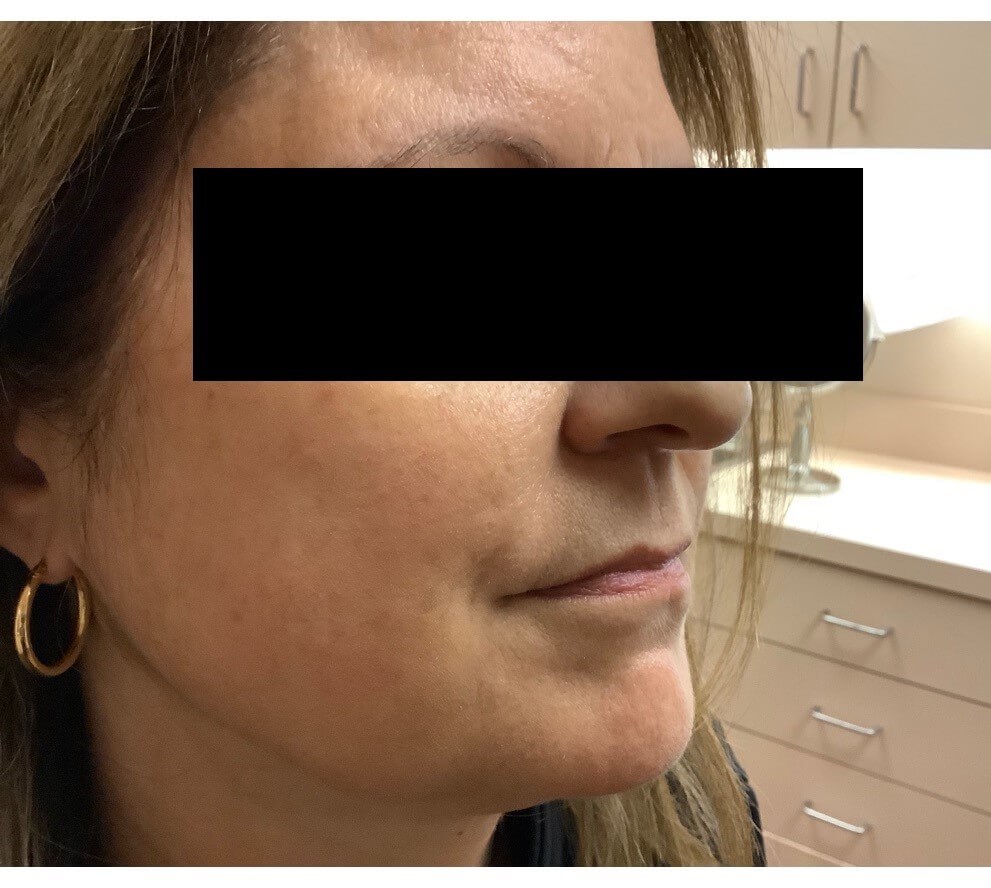 Juvederm Ultra XC After