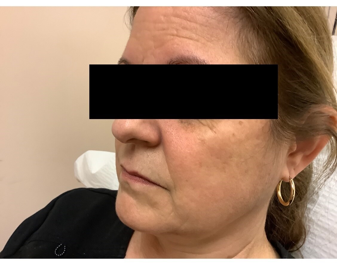 Juvederm Ultra XC Before