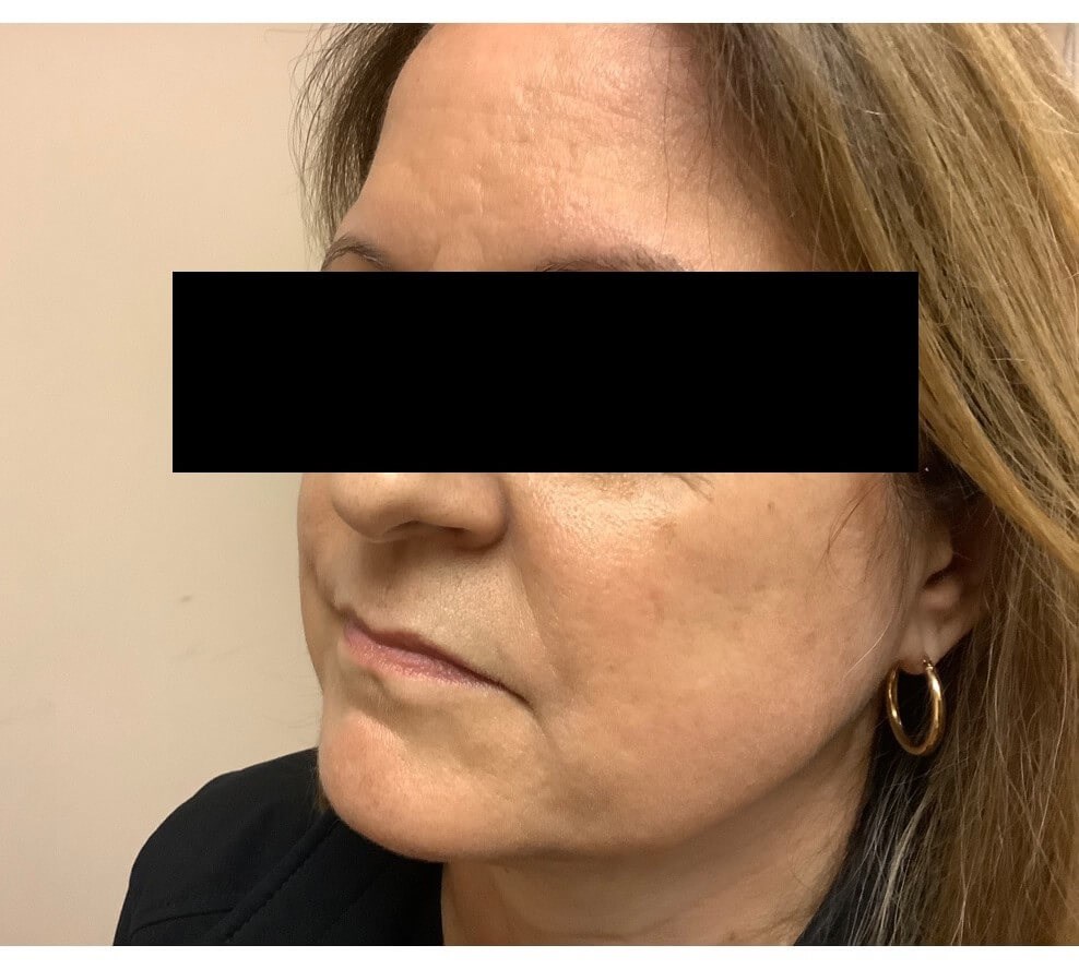 Juvederm Ultra XC After