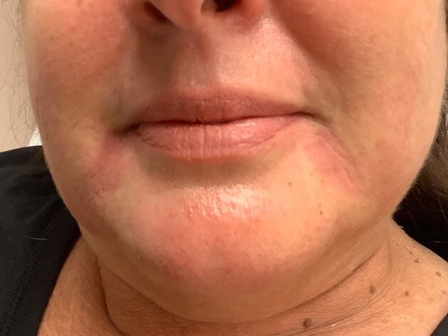 Filler to marionette lines After
