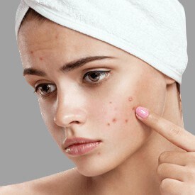Actinic Keratosis